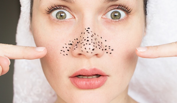 7 blackhead removal masks to swear by for clear and glowing skin