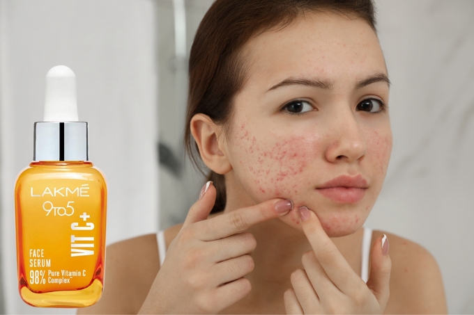 FAQs about How to Deal with Skin Blemishes