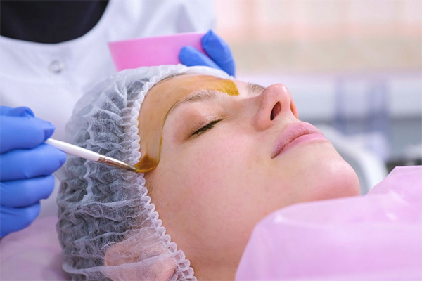 How often should you get a chemical peel