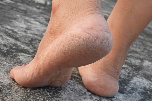 Control the Cracks: How to Deal with Dry Feet