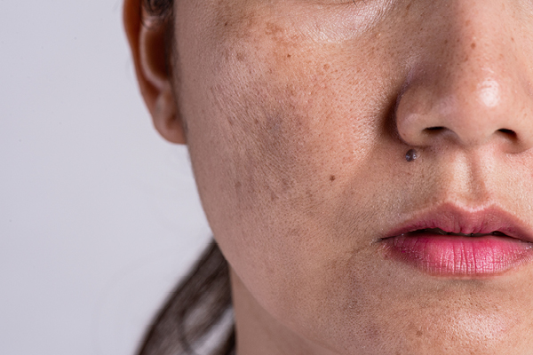 FAQs about Black Dark Spots on Face