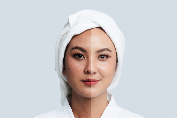 FAQs about Black Dark Spots on Face