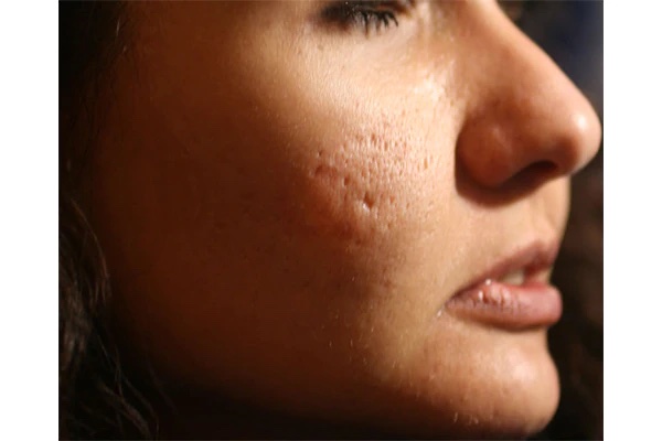 how to get rid of pimple scars