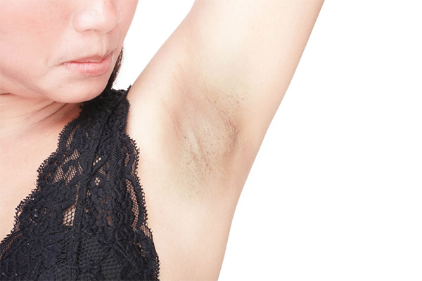 How to get rid of dark underarms: causes and remedies