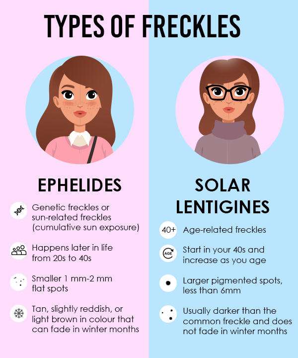 FAQs about freckles