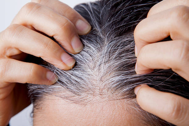 What Causes White Hair at Early Age And How To Prevent It