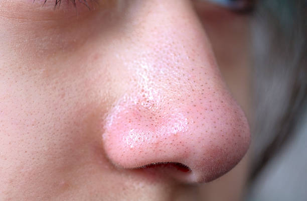 Effective Ways to Remove Blackheads: The Good and the Bad 