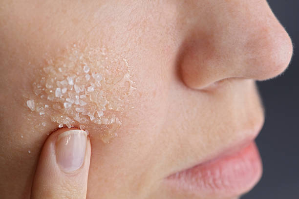 remove blackheads from nose