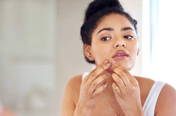 How to Treat Acne and Get Clear Skin