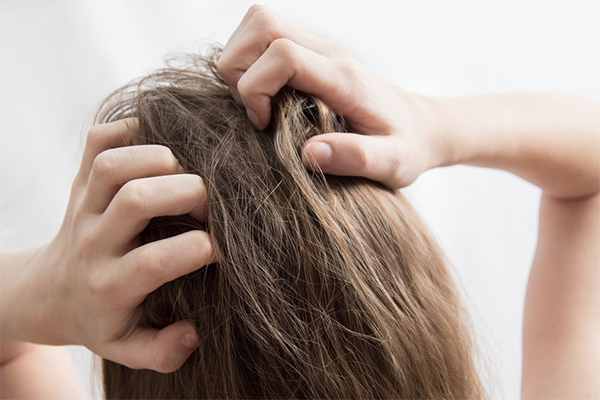 FAQs about the reasons for dandruff