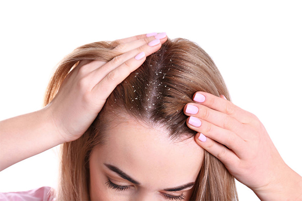 FAQs about the reasons for dandruff