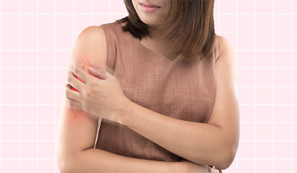 How To Deal With Itchy And Irritated Skin Caused Due To Pcos