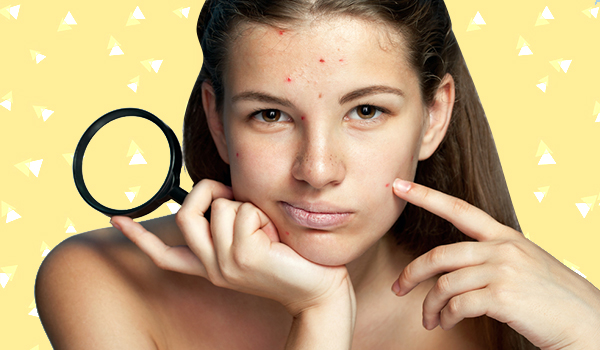 Cystic acne troubling you? Try these remedies to get rid of them in a jiffy