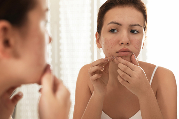 Avoid applying toothpaste on pimples