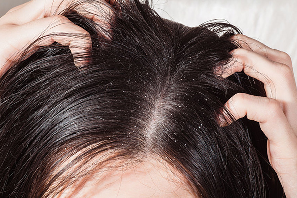3. How to deal with dandruff and dry scalp?